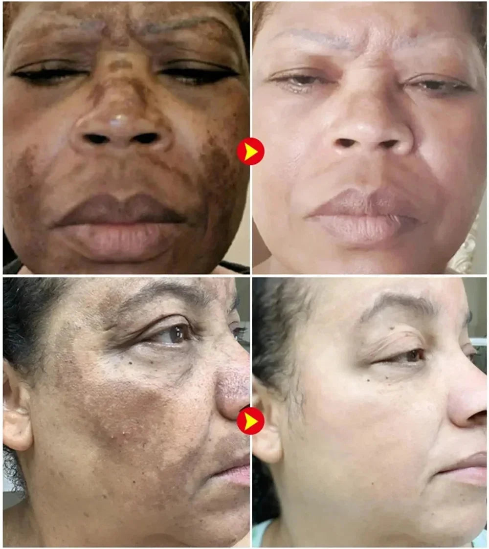Dark Spots Remover Whitening Serum Face Freckle Melanin Correcting Reduce Fine Lines Brighten Essence Korean Beauty Skin Care