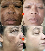 Dark Spots Remover Whitening Serum Face Freckle Melanin Correcting Reduce Fine Lines Brighten Essence Korean Beauty Skin Care