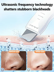 Ultrasonic Skin Scrubber – Facial Pore Cleaner & Exfoliating Device
